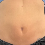 CoolSculpting Before & After Patient #2861