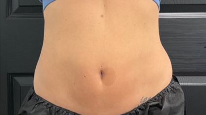 CoolSculpting Before & After Patient #2861