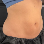 CoolSculpting Before & After Patient #2861