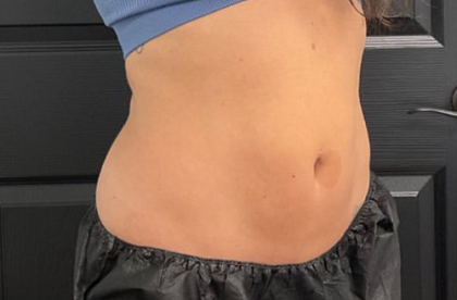 CoolSculpting Before & After Patient #2861