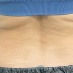 CoolSculpting Before & After Patient #2861