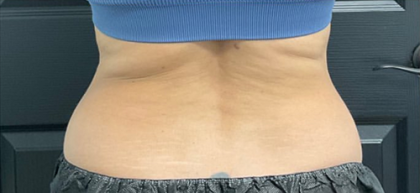 CoolSculpting Before & After Patient #2861