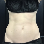 CoolSculpting Before & After Patient #2860