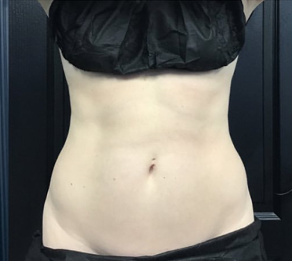 CoolSculpting Before & After Patient #2860