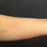 CoolSculpting Before & After Patient #2858