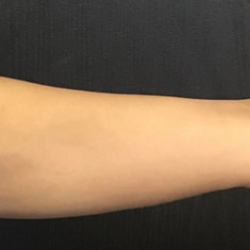 CoolSculpting Before & After Patient #2858