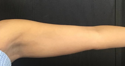 CoolSculpting Before & After Patient #2858