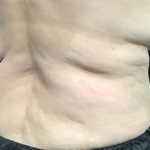 CoolSculpting Before & After Patient #2857