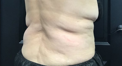 CoolSculpting Before & After Patient #2857