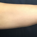 CoolSculpting Before & After Patient #2855