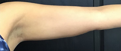 CoolSculpting Before & After Patient #2855