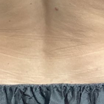 CoolSculpting Before & After Patient #2723