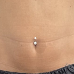 CoolSculpting Before & After Patient #2723