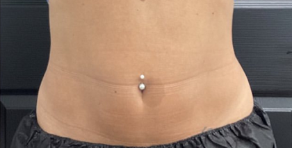 CoolSculpting Before & After Patient #2723