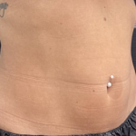 CoolSculpting Before & After Patient #2723