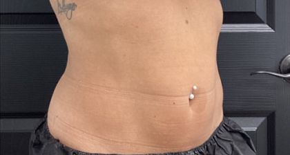 CoolSculpting Before & After Patient #2723