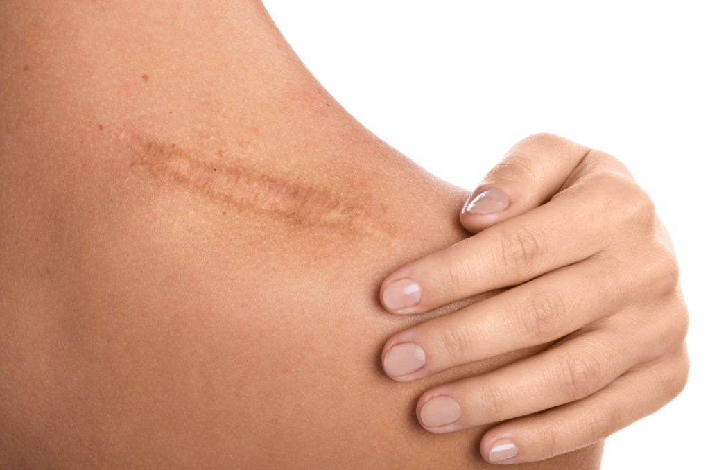 Post-Surgery Scar Reduction with Medspa Treatments