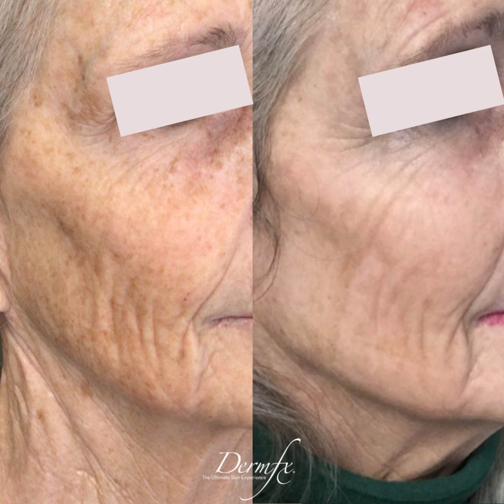 Photofacial (IPL) Dermfx