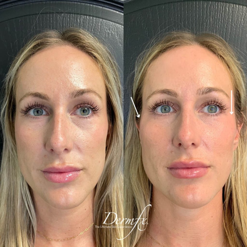 Radiesse Filler Dermfx