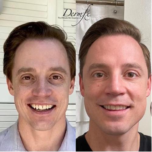 PRF Hair Restoration Dermfx