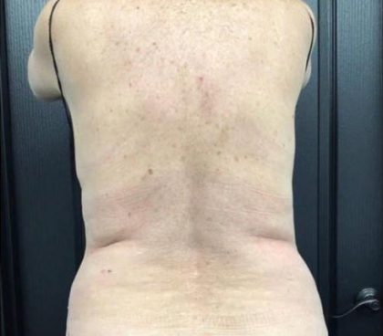 CoolSculpting Before & After Patient #5305