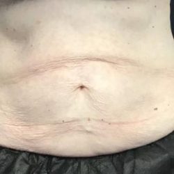CoolSculpting Before & After Patient #5308