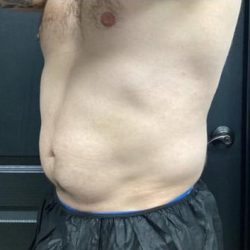 CoolSculpting Before & After Patient #5297