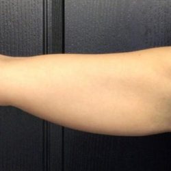 CoolSculpting Before & After Patient #5298