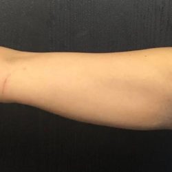 CoolSculpting Before & After Patient #5298